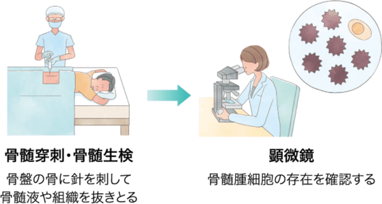 骨髄検査