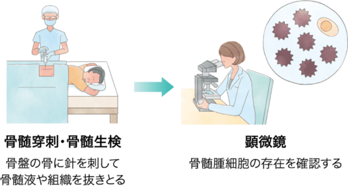 骨髄検査