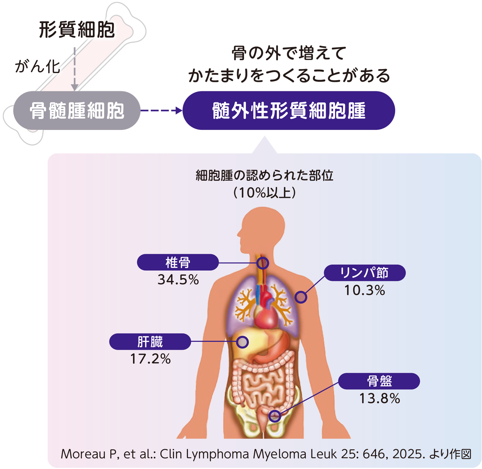 多発性骨髄腫と髄外性形質細胞腫