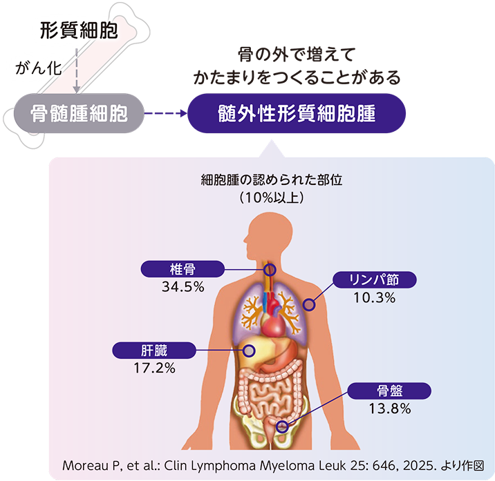多発性骨髄腫と髄外性形質細胞腫